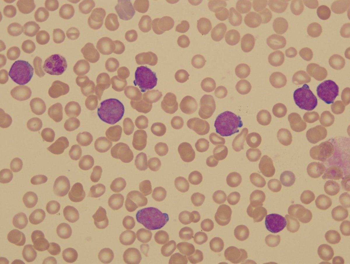 Figure 2-2. The blasts in peripheral blood smear at day 45 of patient with DS